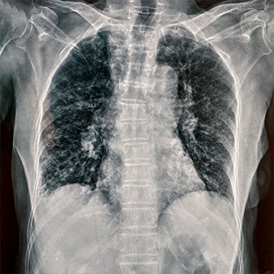 Xray interpretation